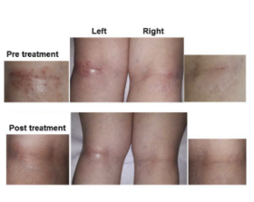 Trattamento della dermatite non atopica con luce policromatica polarizzata priva di raggi UV - Bioptron Doctor's Corner photo