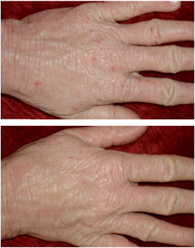 Dermatite atopica - Testimonial photo